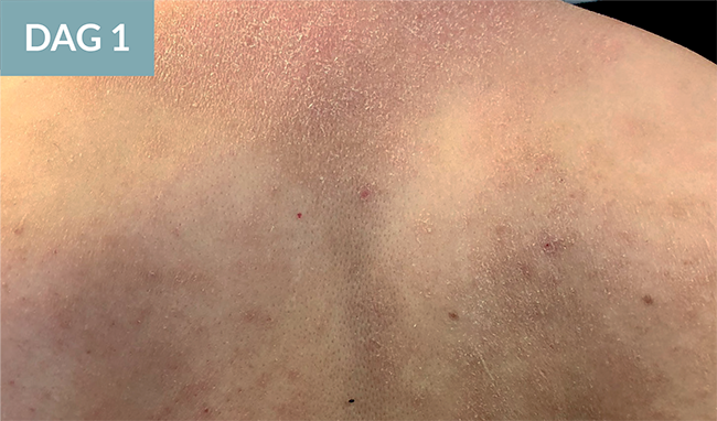 Dag 1 - 20-årig mand med atopisk dermatitis 