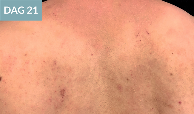 Dag 21 - 20-årig mand med atopisk dermatitis 