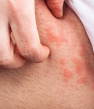 Inkontinensrelateret dermatitis (IAD) | Kløende og irriteret hud