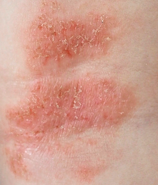 Atopic dermatitis (AD) skin