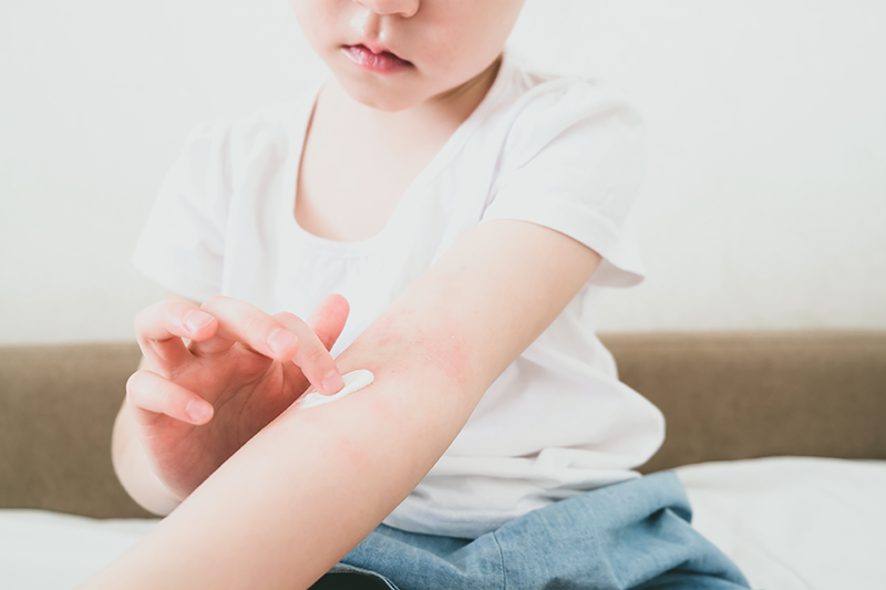 Managing dry skin in children with AD